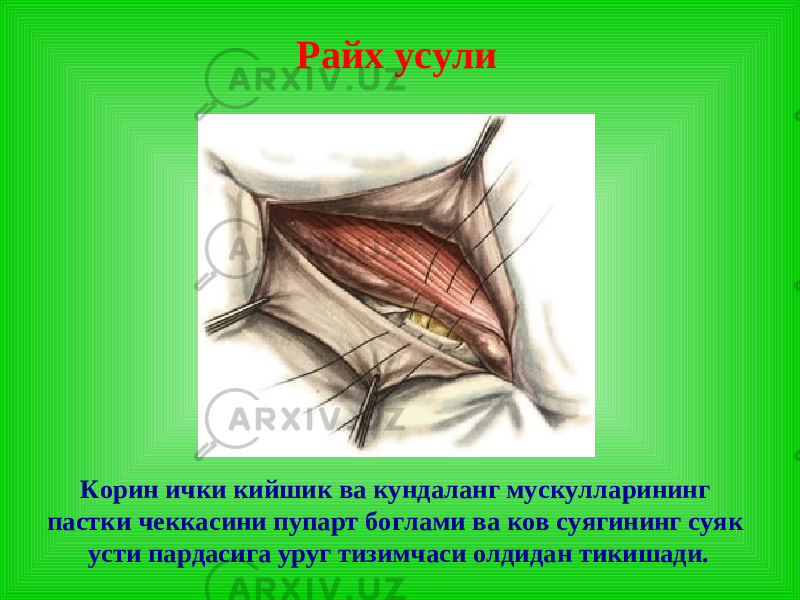 Райх усули Корин ички кийшик ва кундаланг мускулларининг пастки чеккасини пупарт боглами ва ков суягининг суяк усти пардасига уруг тизимчаси олдидан тикишади. 