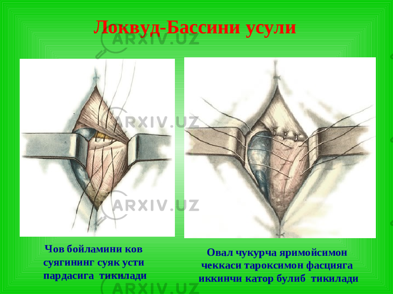 Локвуд-Бассини усули Чов бойламини ков суягининг суяк усти пардасига тикилади Овал чукурча яримойсимон чеккаси тароксимон фасцияга иккинчи катор булиб тикилади 