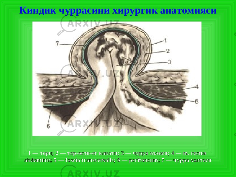 Киндик чурраси ни хирургик анатомияси 1 — тери; 2 — тер-ости-ег кавати; 3 — чурра аъзоси; 4 — m. rectus abdominis; 5 — fascia transversalis; 6 — peritoneum; 7 — чурра халтаси 