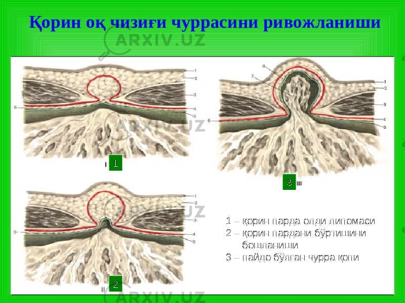 Қорин оқ чизиғи чуррасини ривожланиши 1 – қорин парда олди липома си 2 – қорин пардани бўртишини бошланиши 3 – пайдо бўлган чурра қопи1 2 3 