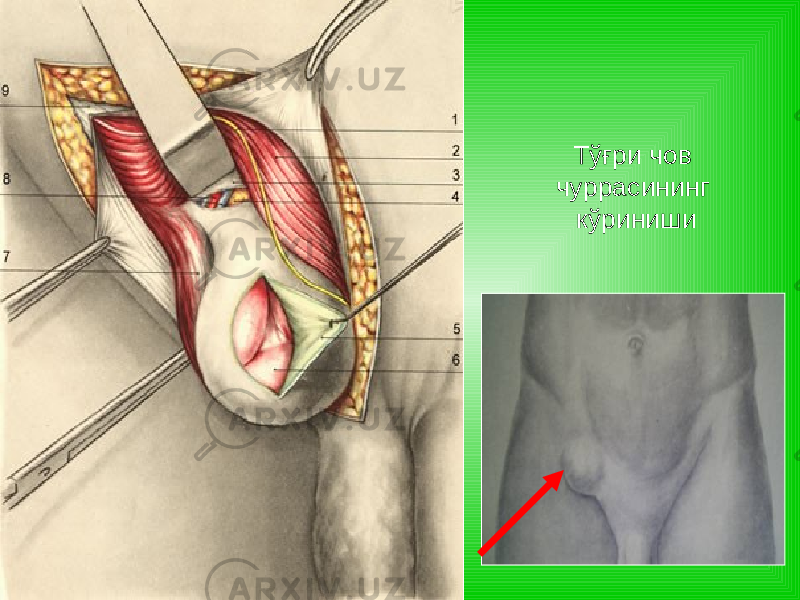 Тўғри чов чуррасининг кўриниши 