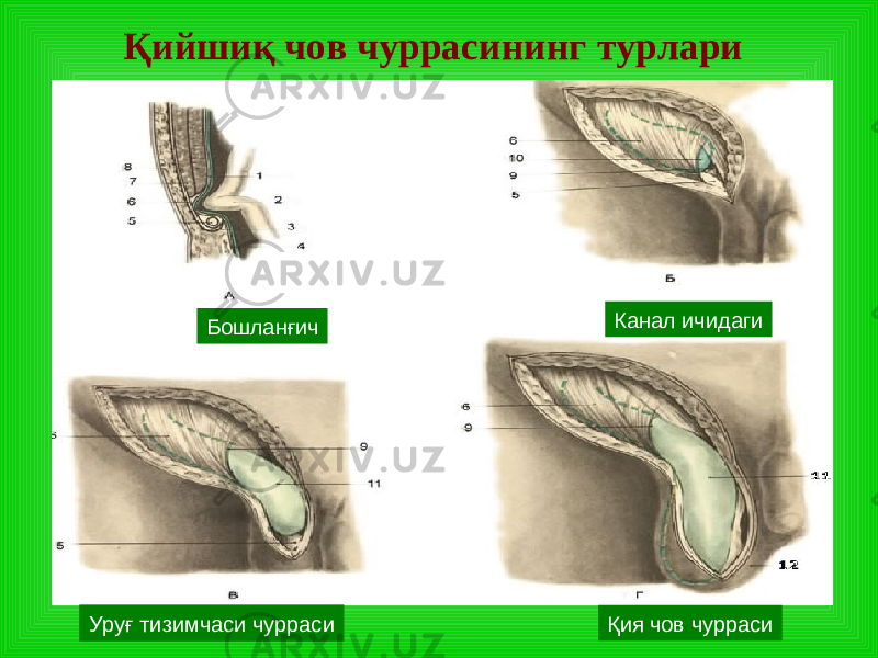 Қийшиқ чов чуррасининг турлари Бошланғич К ана л ичидаги Уруғ тизимчаси чурраси Қия чов чурраси 