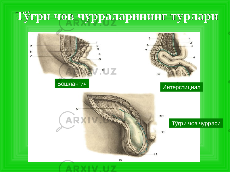 Тўғри чов чурраларининг турлари Бошланғич И нтерстициал Тўғри чов чурраси 