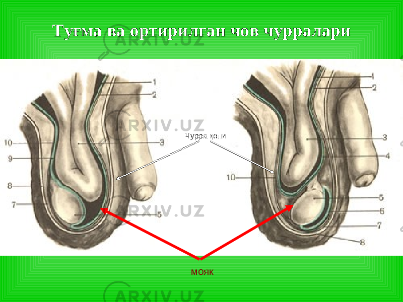 Туғма ва ортирилган чов чурралари моякЧурра қопи 