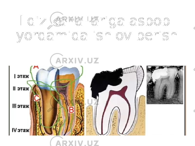 Ildiz kanallariga asbob yordamida ishlov berish 