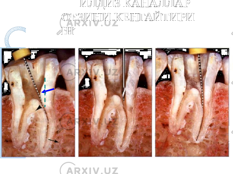 ИЛДИЗ КАНАЛЛАР ОҒЗИНИ КЕНГАЙТИРИ Ш 