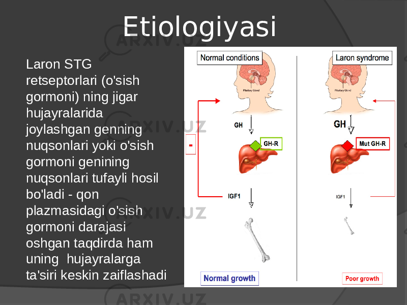 Etiologiyasi Laron STG retseptorlari (o&#39;sish gormoni) ning jigar hujayralarida joylashgan genning nuqsonlari yoki o&#39;sish gormoni genining nuqsonlari tufayli hosil bo&#39;ladi - qon plazmasidagi o&#39;sish gormoni darajasi oshgan taqdirda ham uning hujayralarga ta&#39;siri keskin zaiflashadi 