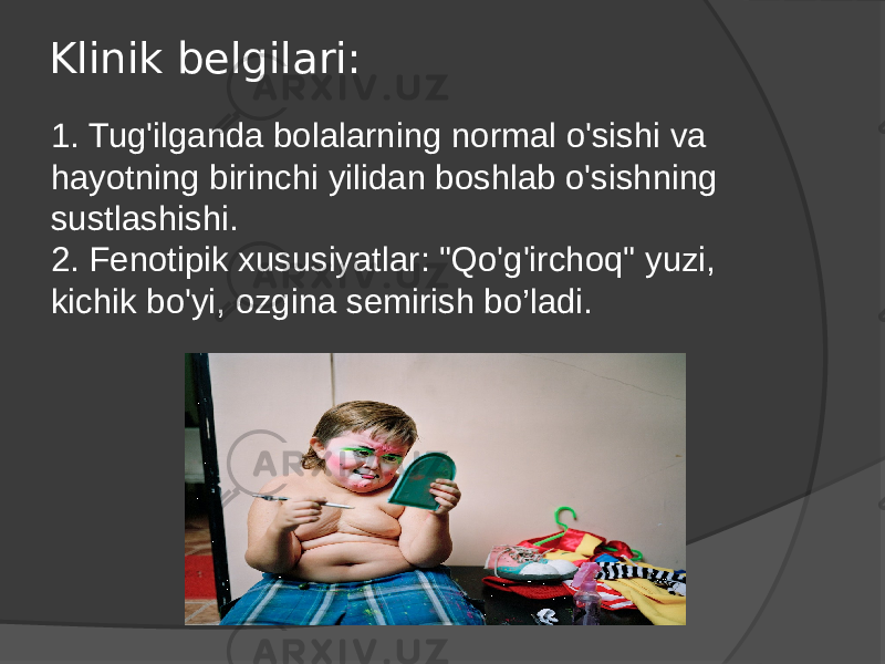 Klinik belgilari: 1. Tug&#39;ilganda bolalarning normal o&#39;sishi va hayotning birinchi yilidan boshlab o&#39;sishning sustlashishi. 2. Fenotipik xususiyatlar: &#34;Qo&#39;g&#39;irchoq&#34; yuzi, kichik bo&#39;yi, ozgina semirish bo’ladi. 