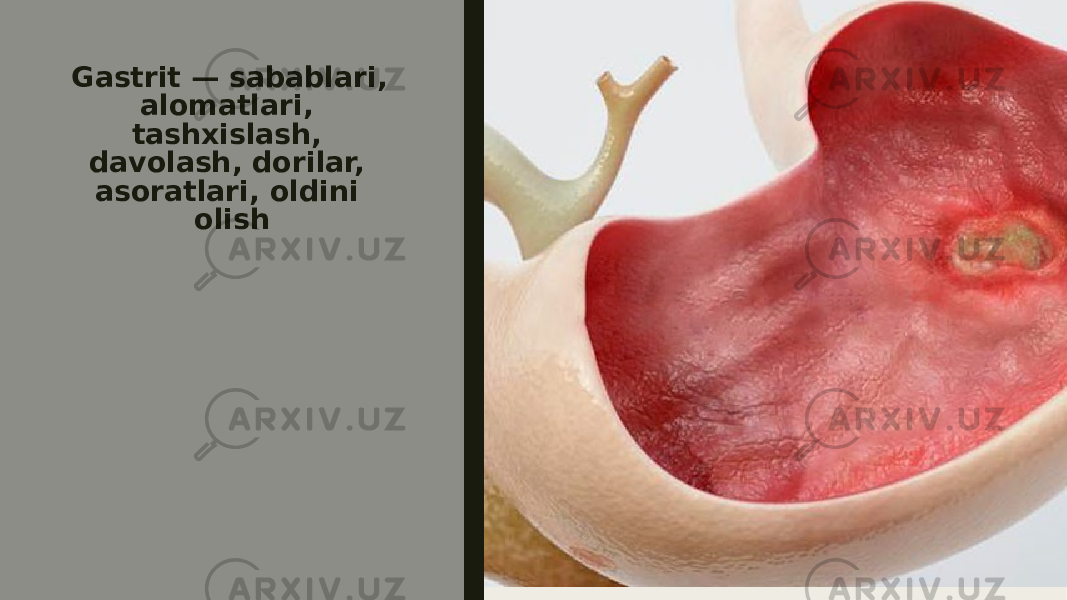 Gastrit — sabablari, alomatlari, tashxislash, davolash, dorilar, asoratlari, oldini olish 