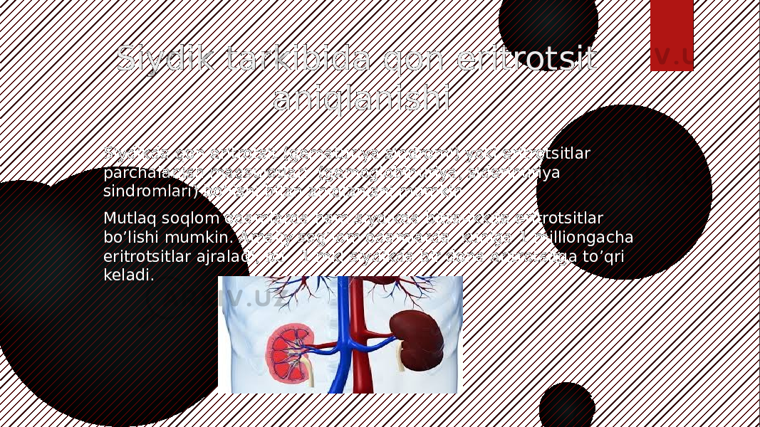 Siydik tarkibida qon eritrotsit aniqlanishi Siydikda qon eritrotsit (gematuriya sindromi) yoki eritrotsitlar parchalanish maqsulotlari (gemoglobinuriya, siderinuriya sindromlari) bo’lishi bilan aniqlanishi mumkin Mutlaq soqlom odamlarda ham siydikda bitta-ikkita eritrotsitlar bo’lishi mumkin. Amaliy sog’lom odamlarda kuniga 1 milliongacha eritrotsitlar ajraladi, bu 1 mkl siydikda bir dona eritrotsitga to’qri keladi. 