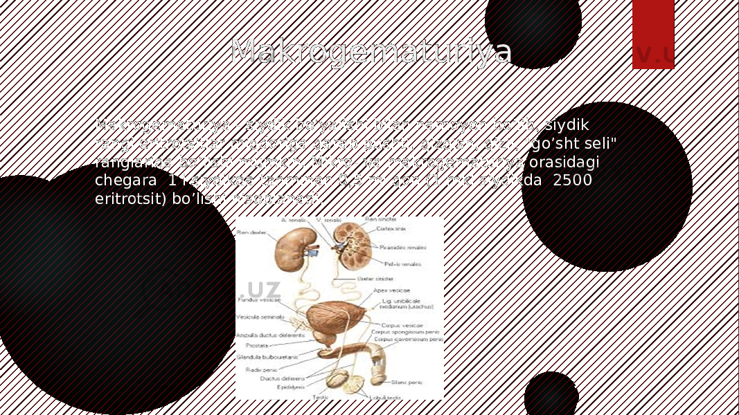  Makrogematuriya Makrogematuriya - siydik bo’yalishi bilan namoyon bo’lib, siydik rangi eritrotsitlar miqdoriga qarab pushti, qizqish, qizil, &#34;go’sht seli&#34; ranglarida bo’lishi mumkin. Mikro- va makrogematuriya orasidagi chegara 1 l siydikda tahminan 0,5 ml qon (1 mkl siydikda 2500 eritrotsit) bo’lishi hisoblanadi. 