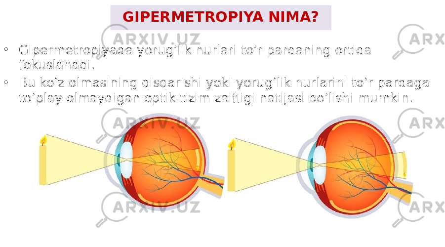 GIPERMETROPIYA NIMA? • Gipermetropiyada yorug’lik nurlari to’r pardaning ortida fokuslanadi. • Bu ko’z olmasining qisqarishi yoki yorug’lik nurlarini to’r pardaga to’play olmaydigan optik tizim zaifligi natijasi bo’lishi mumkin. 